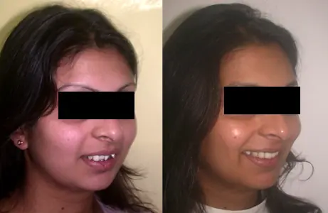 Case Study 01 — before and after orthodontic treatment