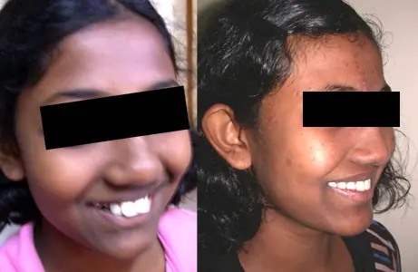 Case Study 02 — before and after orthodontic treatment
