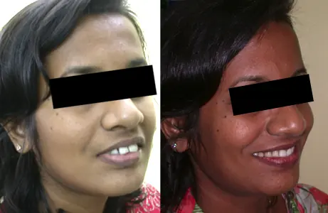Case Study 03 — before and after orthodontic treatment