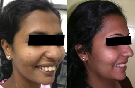 Case Study 04 — before and after orthodontic treatment